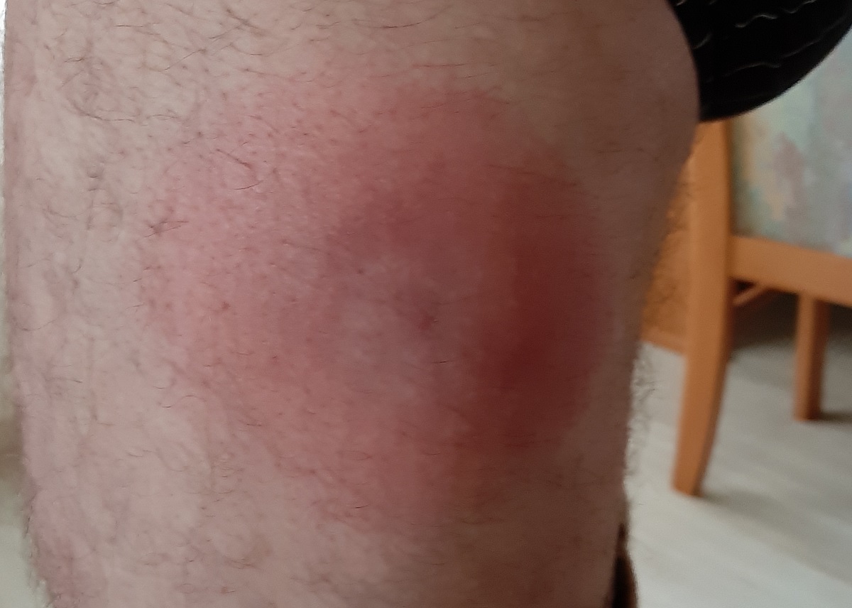 Wenn die Zecke zubeißt – Borreliose und jetzt auch FSME